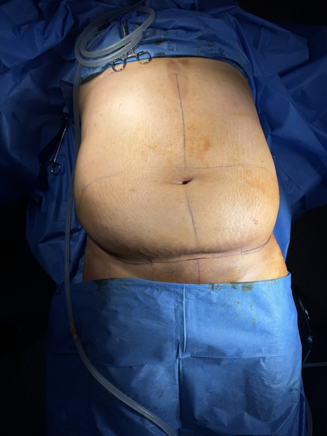 Resultado de lipoescultura